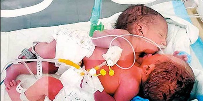twins birth
