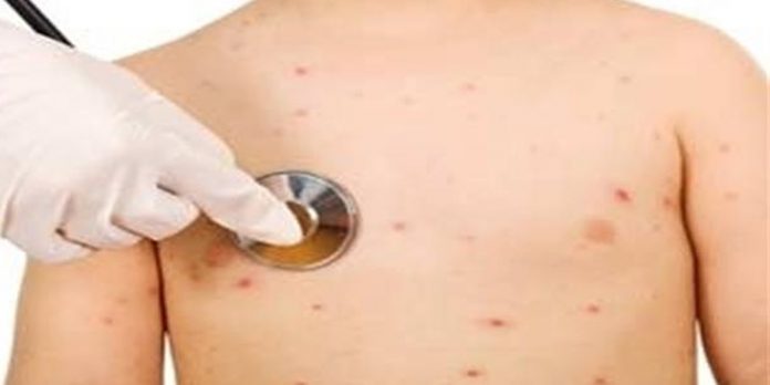small pox