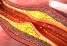 இந்த அறிகுறிகள் இருந்தால் உங்கள் உடலில் ஆபத்தான கொழுப்பு (cholesterol) அதிகமாக இருக்கு என்கிறது ஆய்வு