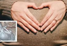 35 ஆண்டுகளாக வயிற்றில் குழந்தையுடன் வாழ்ந்து வந்த 73 வயது மூதாட்டி