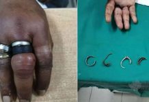 அழகுக்காக போட்டிருந்த மோதிரங்களால் ஏற்பட்ட வேதனை