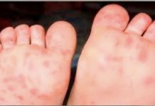 நெகிரியில் இந்தாண்டு 958 HFMD வழக்குகள் பதிவாகியிருக்கிறது