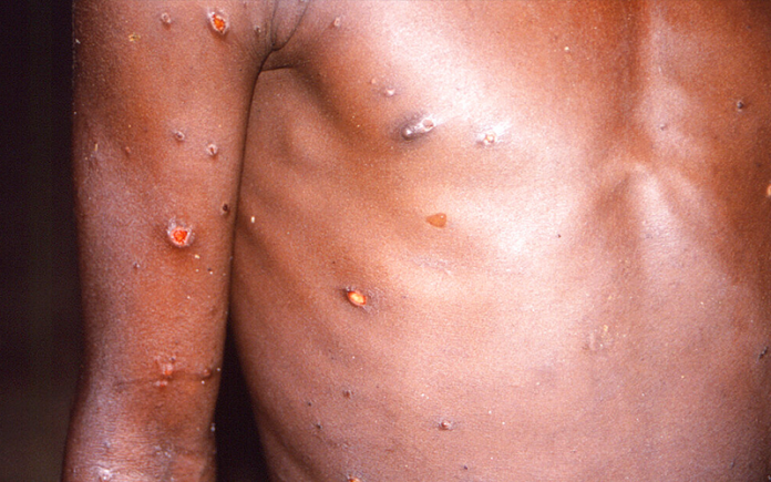 MONKEYPOX