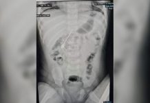 5.5 செ.மீட்டர் ஊசியை விழுங்கிய 7 மாத குழந்தை