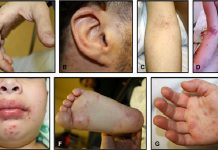 கிளாந்தானில் உள்ள 9 மாவட்டங்களில் கை, கால் மற்றும் வாய் நோய் சிவப்பு மண்டலத்தில் பட்டியலிடப்பட்டுள்ளன