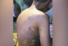 9 வயது மகனின் தீக்காயத்திற்கு சரியான சிகிச்சை வழங்காத பெற்றோர் மீதான வழக்கு முடிவுக்கு வந்துள்ளதாக போலீஸ் தகவல்
