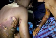 தீக்காயமடைந்த மகனுக்கு மருத்துவ சிகிச்சை அளிக்க தவறிய குற்றச்சாட்டில் பெற்றோர் கைது