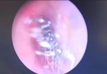 பெண்ணின் காதுக்குள் சிலந்தி வலை கட்டிய சம்பவம்; மருத்துவர்கள் அதிர்ச்சி