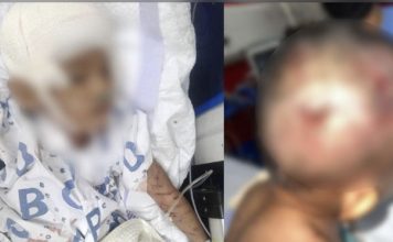தெரு நாய்களின் தாக்குதலுக்கு ஆளான 4 வயது சிறுவன்