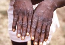 மலேசியாவில் இருவருக்கு குரங்கம்மை கண்டறியப்பட்டுள்ளது