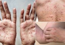 குரங்கம்மை அறிகுறி குறித்து எச்சரிக்கையாக இருப்பீர்