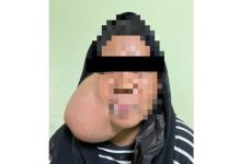 பெண்ணின் முகத்தில் இருந்த 1.03 கிலோ கட்டி நீக்கம் ; லஹாட் டத்து மருத்துவமனை சாதனை