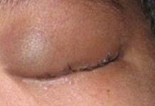 ஆசிரியர் அடித்ததால் கண்ணில் காயம் ஏற்பட்டதாக மாணவர் புகார்