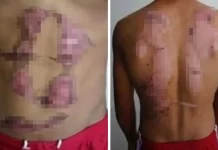 Budak didera guna seterika, air panas, suami isteri ditahan