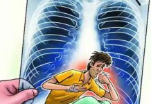 தமிழகத்தில் 6 மாதங்களில் 42,486 பேருக்கு காசநோய் பாதிப்பு