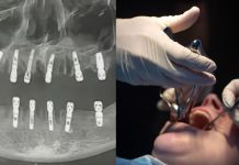 ஒரே நாளில் 23 பற்களையும் பிடுங்கிய மருத்துவர்கள்.. மாரடைப்பால் பறிபோன உயிர்