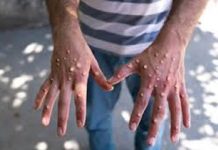 Mpox – அதிக ஆபத்துள்ள நாடுகளில் இருந்து திரும்பி வரும் கிளந்தான் குடியிருப்பாளர்கள் JKNK க்கு புகாரளிக்க வலியுறுத்தப்பட்டனர்