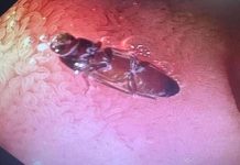 வயிற்றுக்குள் கரப்பான் பூச்சி; வலியால் துடித்த வாலிபர்: டாக்டர்கள் செய்த ‘மேஜிக்’