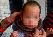 Besi pelapik dapur sangkut di leher kanak-kanak