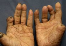 KKM menyiasat punca wabak kusta di Kuala Pilah