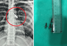 நுரையீரலில் சிக்கிய 7 ஆணிகள்.. 19 வயது இளைஞருக்கு ஷாக்