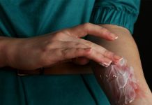 தீக்காயம் ஏற்பட்ட இடத்தில் கிரீம்கள், லோஷன்களை பயன்படுத்தாதீர்; மருத்துவர் ஆலோசனை