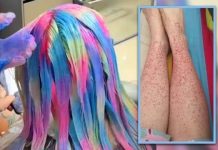 ஹேர் டை பழக்கத்தின் கடும் விளைவு: சிறுநீரகப் பாதிப்பு!